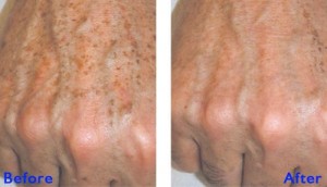 before & after hands peels